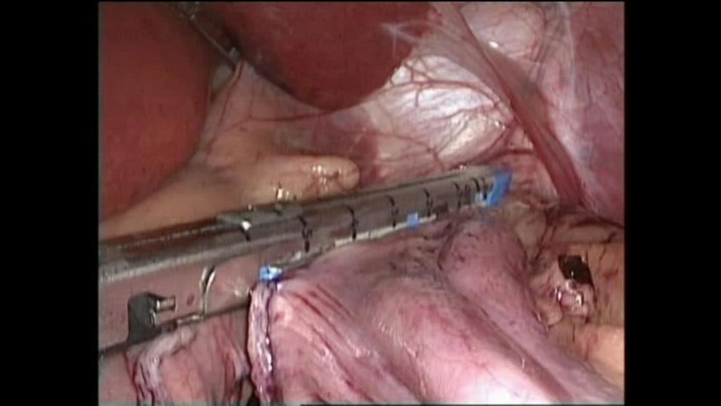 SleeveGastrectomyImg